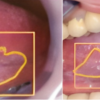 AI and Oral Cancer