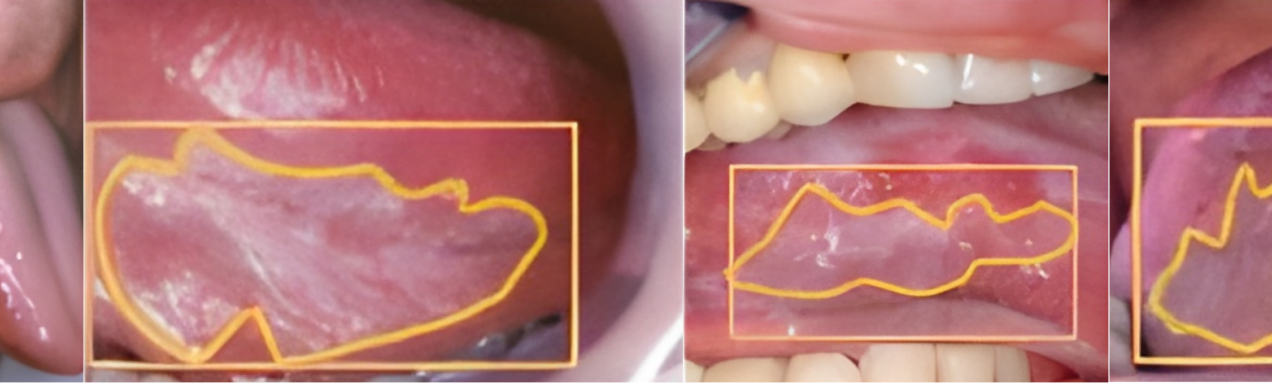 AI and Oral Cancer