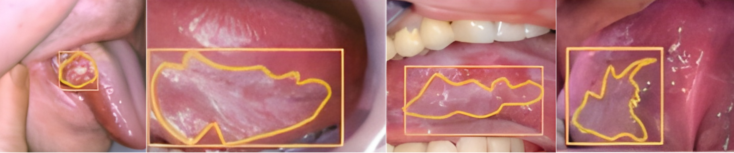 AI and Oral Cancer
